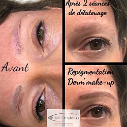 Détatouage et correction maquillage permanent